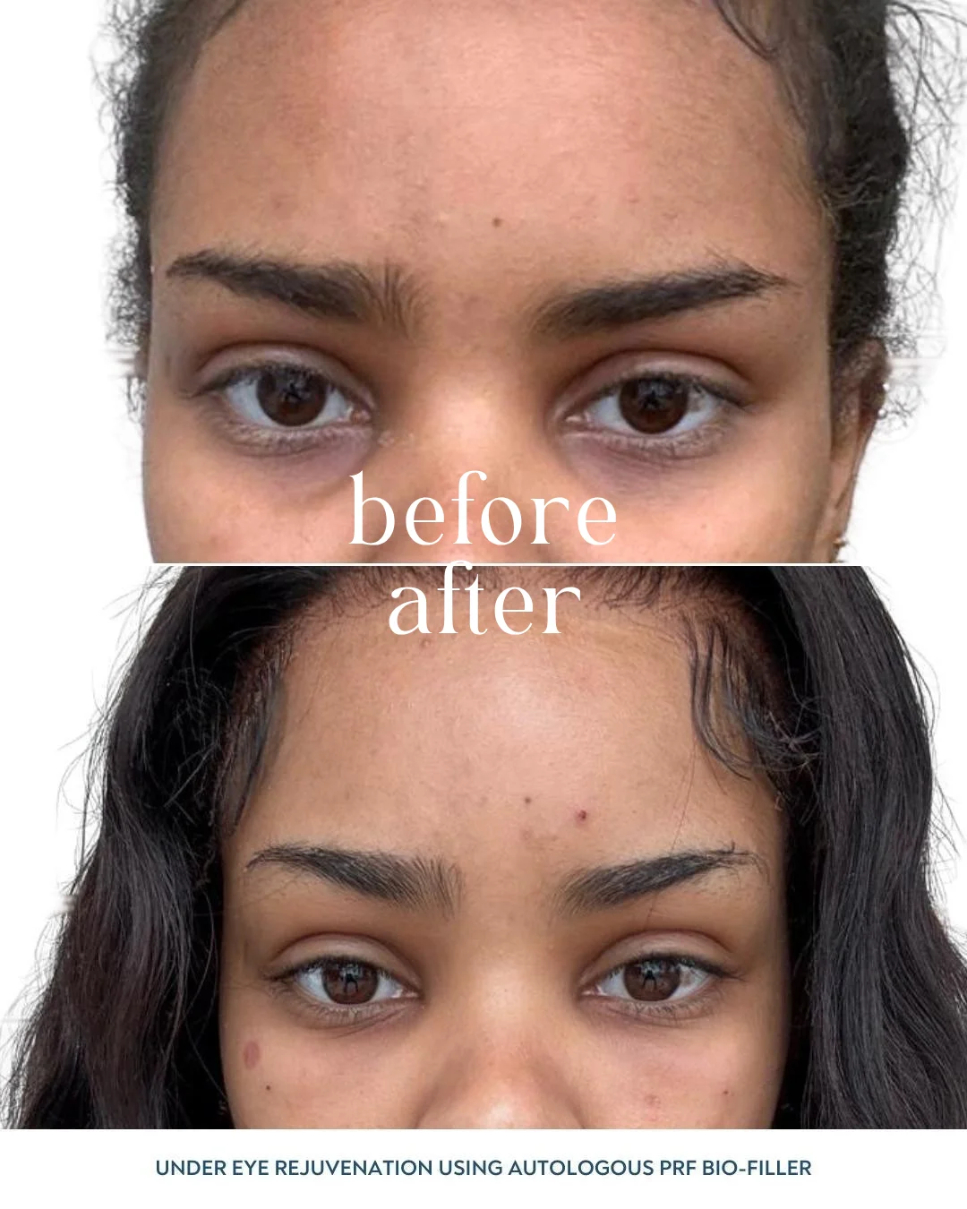 Combination Protocol: Patient received 3 sessions of PRP for dark circle correction and skin rejuvenation, followed by 1 session of PRF Biofiller to restore tear trough volume. Results demonstrate comprehensive periorbital restoration.