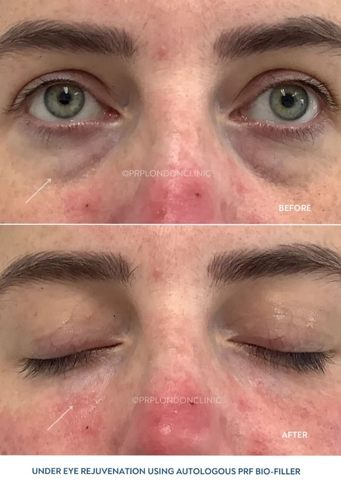 Mid-face and under-eye hollowing corrected with PRF Biofiller. Natural results demonstrating the biocompatible volumisation of EZ Gel.