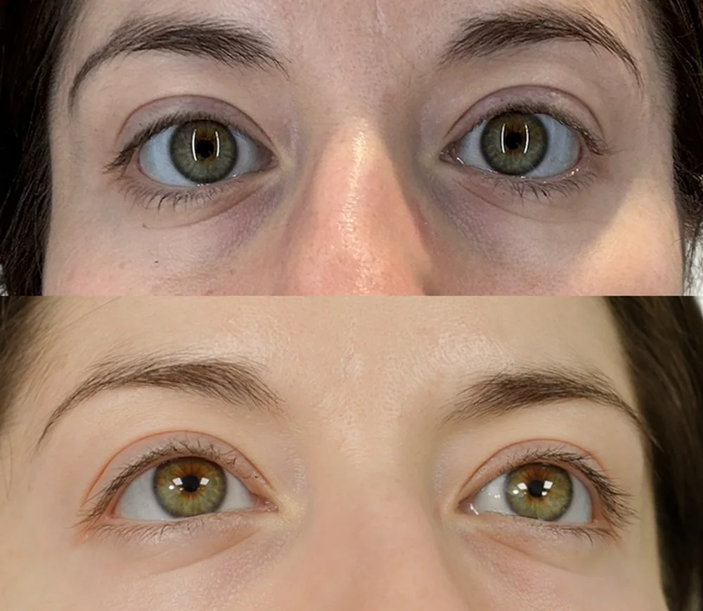 PRF Biofiller London before and after – tear trough with vascular shadow and under-eye dark circles after two sessions of autologous PRF
