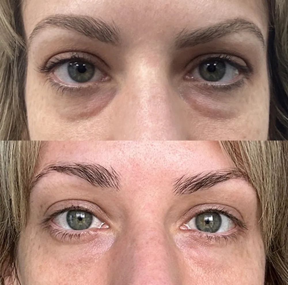 PRF Biofiller London before and after – tear trough correction for periorbital hollowing following weight loss