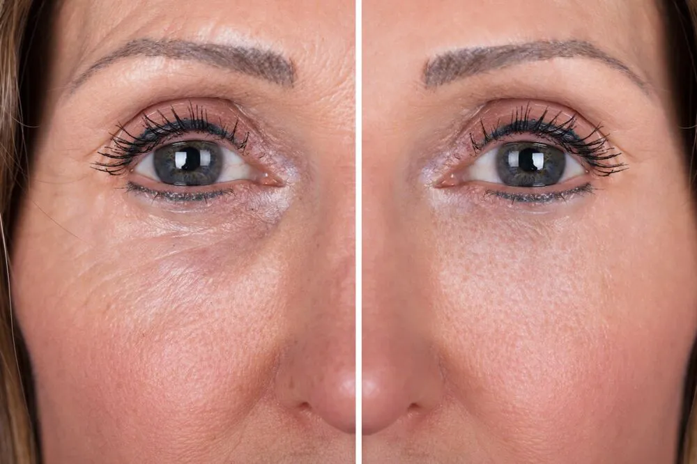 Illustration of Profhilo injection points on a face for skin rejuvenation.
