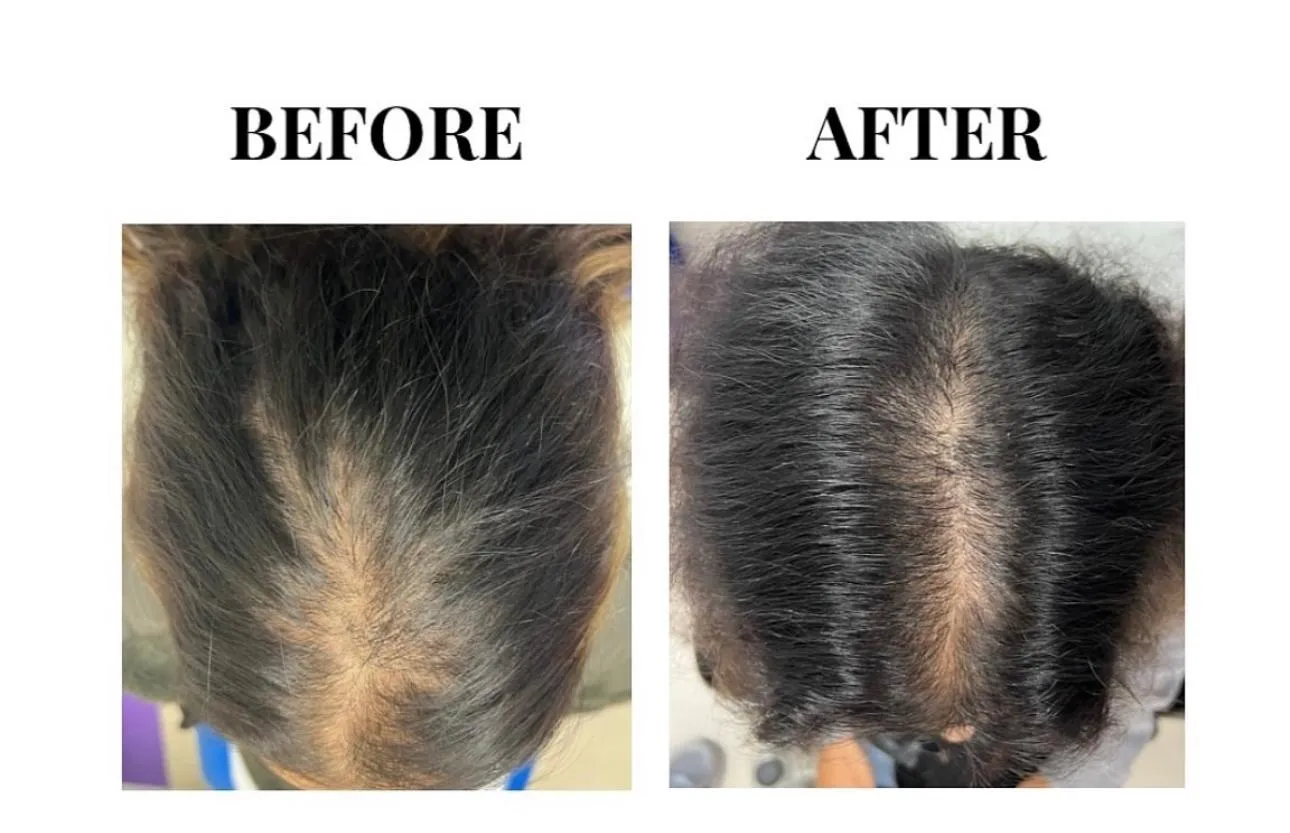 Before and after results of PRP hair treatment using Rein PRP tubes - female patient