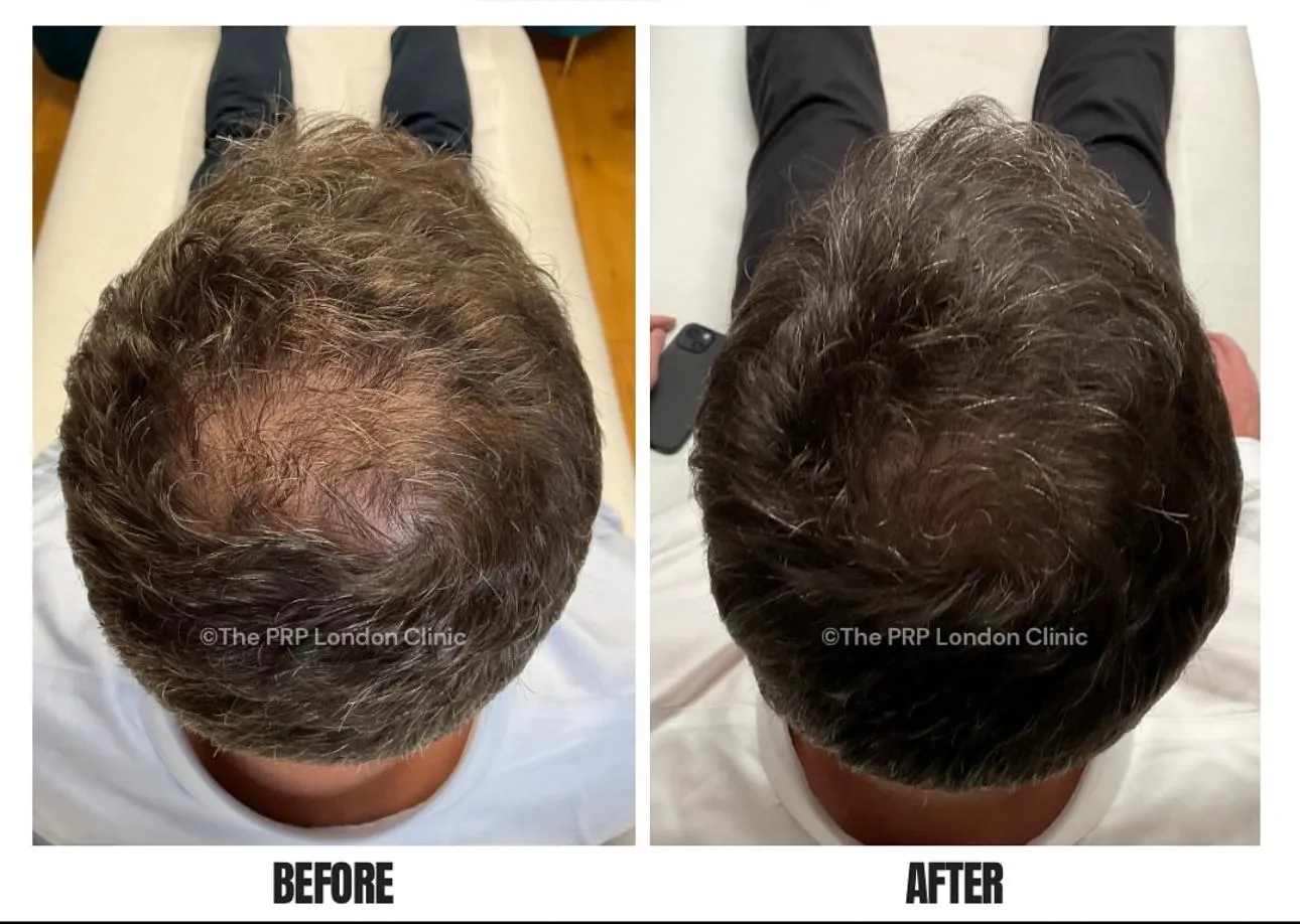 Before and after results of PRP hair treatment using Rein PRP tubes - male patient