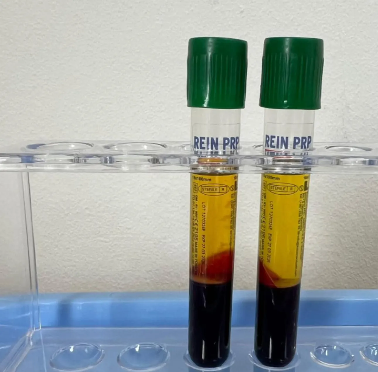 Rein PRP tubes showing clear separation of blood components after centrifugation