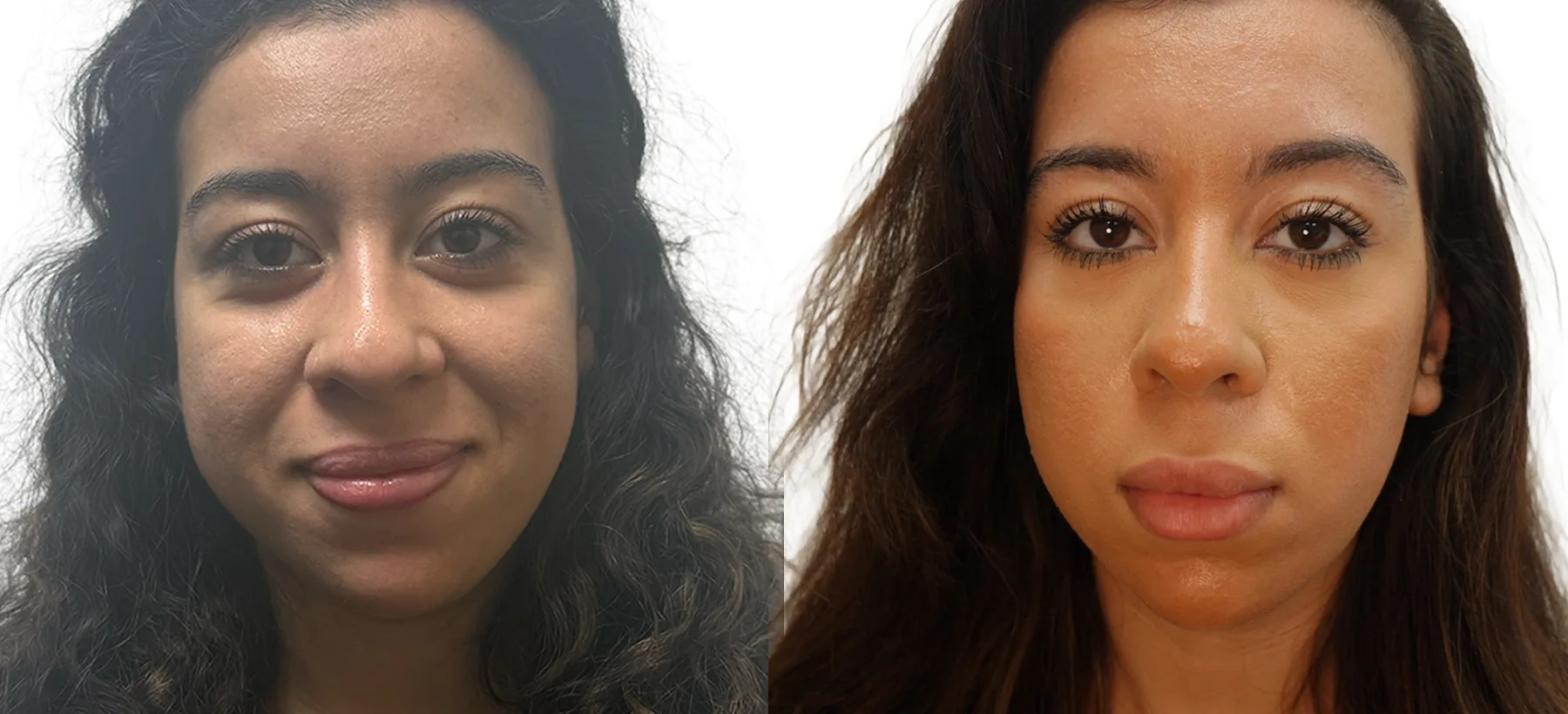Cheek filler before and after, full facial restructuring with 1.6ml Revolax to the cheeks and 1ml to the temples at PRP London Clinic