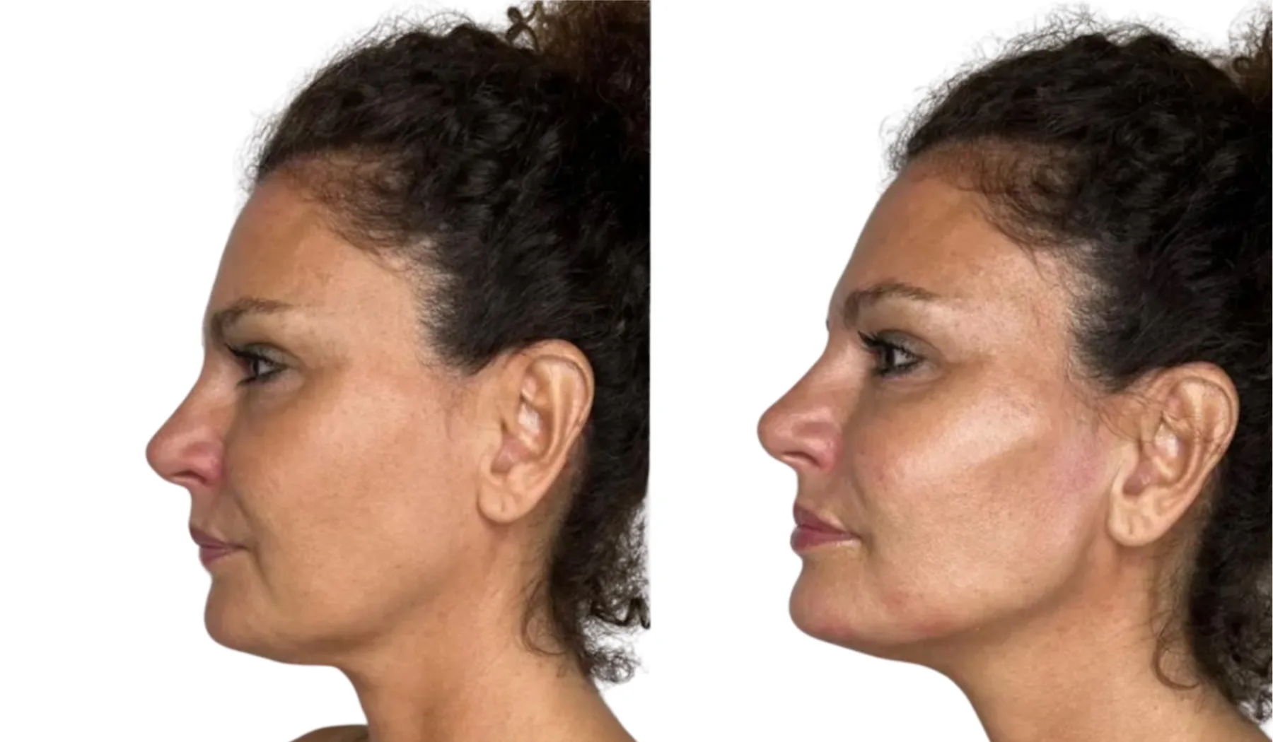 juvederm cheek fillers before after photos showing cheekbone contouring and facial definition results