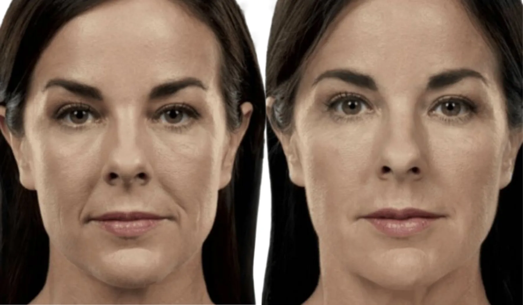 juvederm cheek filler before and after showing mid-face volume restoration and improved cheek fullness