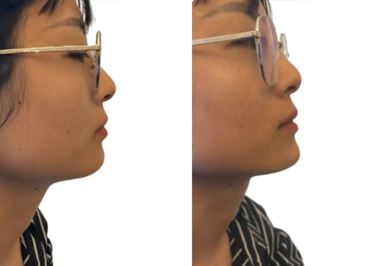 Chin augmentation before and after showing 1ml Voluma chin filler combined with Sculptra bio-stimulator on temples and jawline using cannula fanning technique by Dr Bruno Amendola at PRP London Clinic London