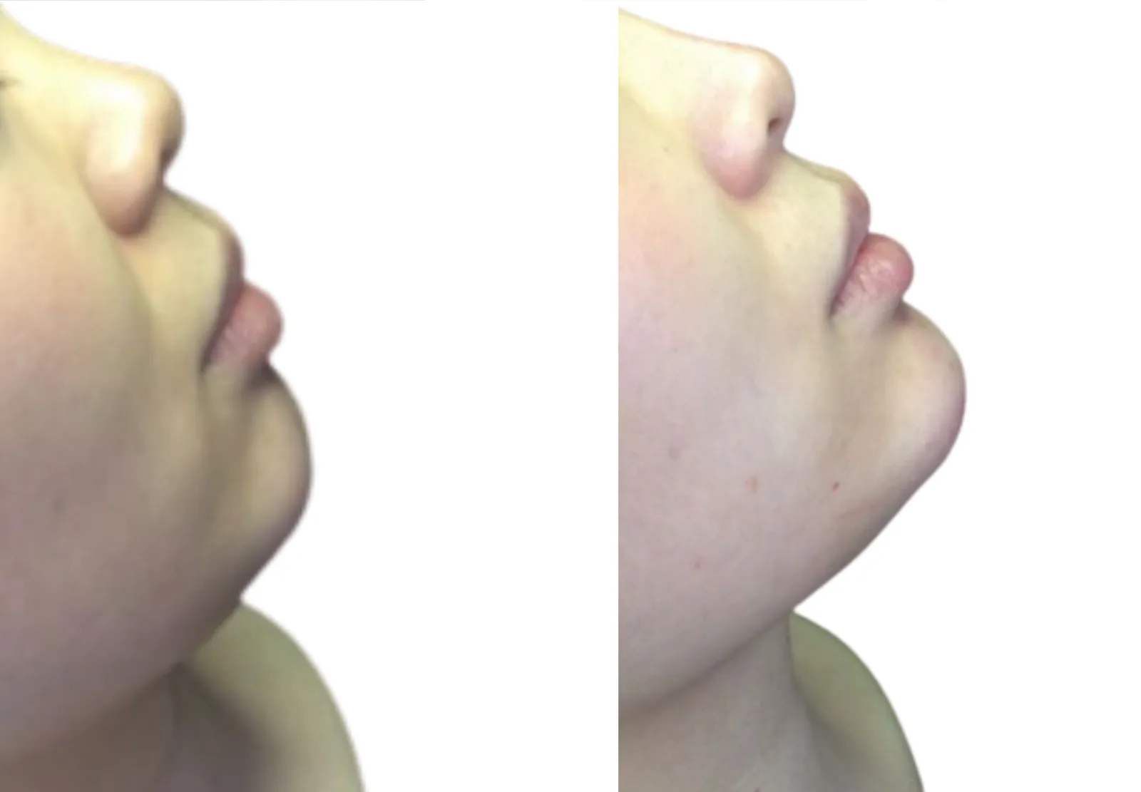 Chin filler before and after showing chin and jawline augmentation with 2ml Juvéderm Voluma for profile transformation by Dr Bruno Amendola at PRP London Clinic London