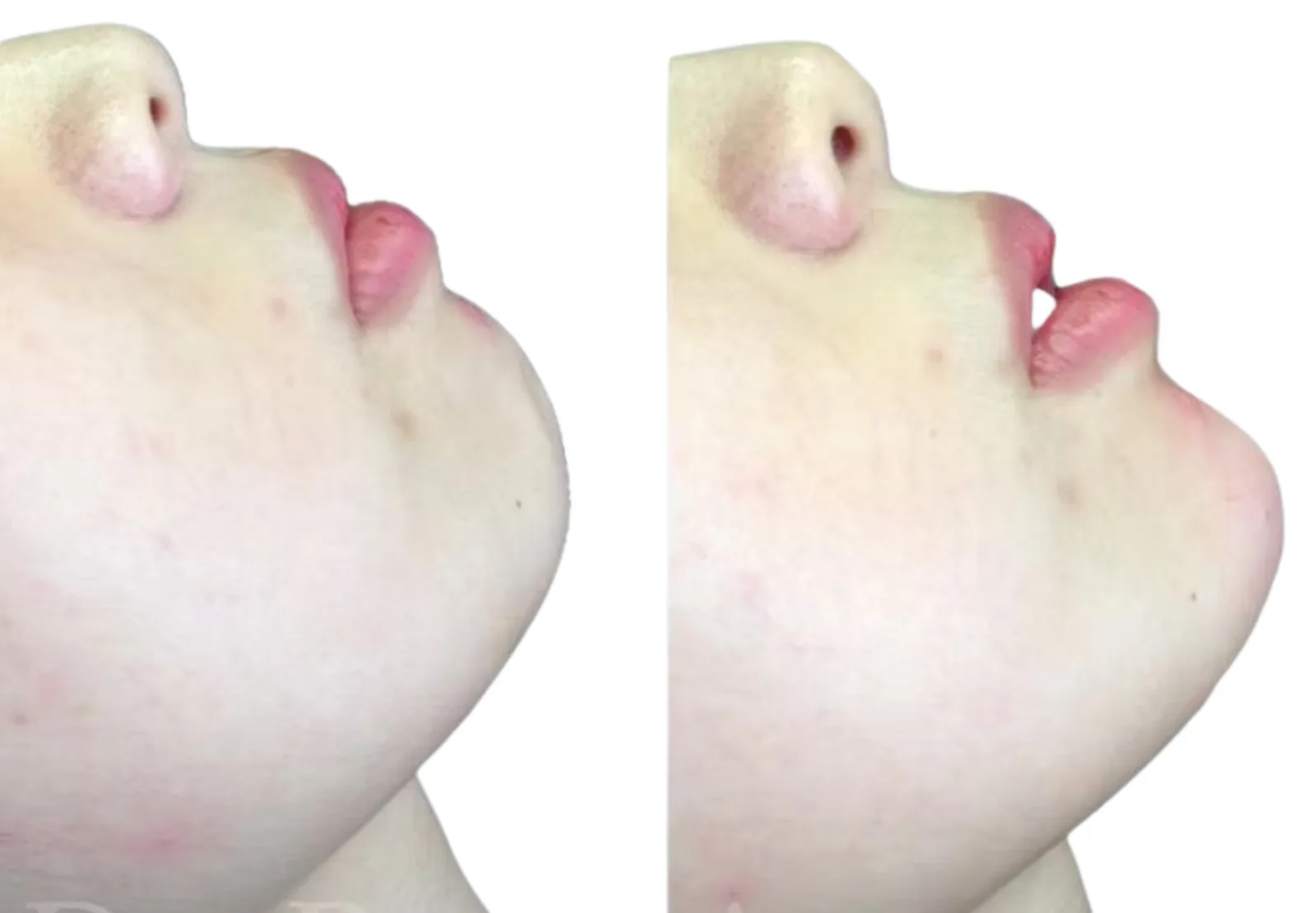 Chin filler before and after showing double chin correction with 1ml Voluma chin projection and 1ml Volift jawline definition by Dr Bruno Amendola at PRP London Clinic London