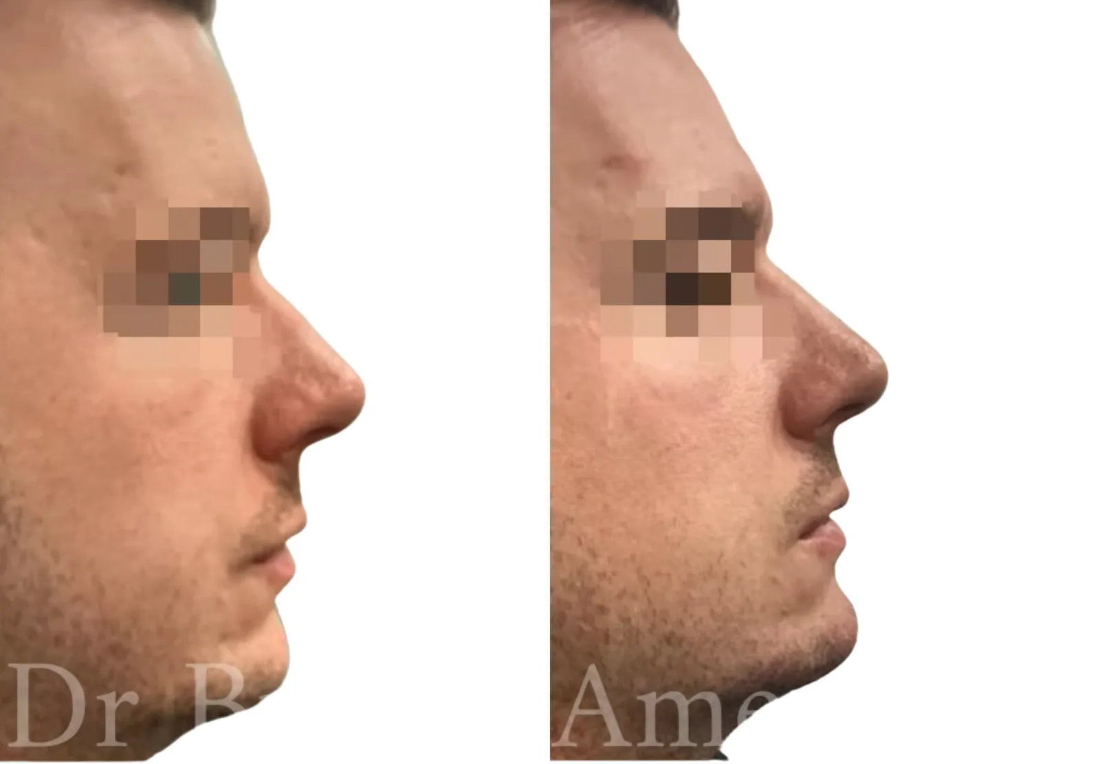 Male chin filler before and after showing subtle chin augmentation with 0.8ml Juv éderm Voluma for profile projection by Dr Bruno Amendola at PRP London Clinic London