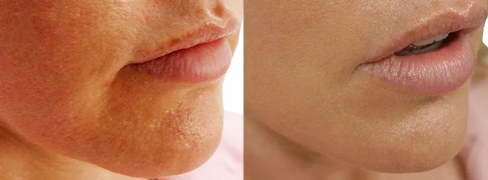 Chin close-up before and after showing visible pore refinement and smoother skin texture, London clinic patient