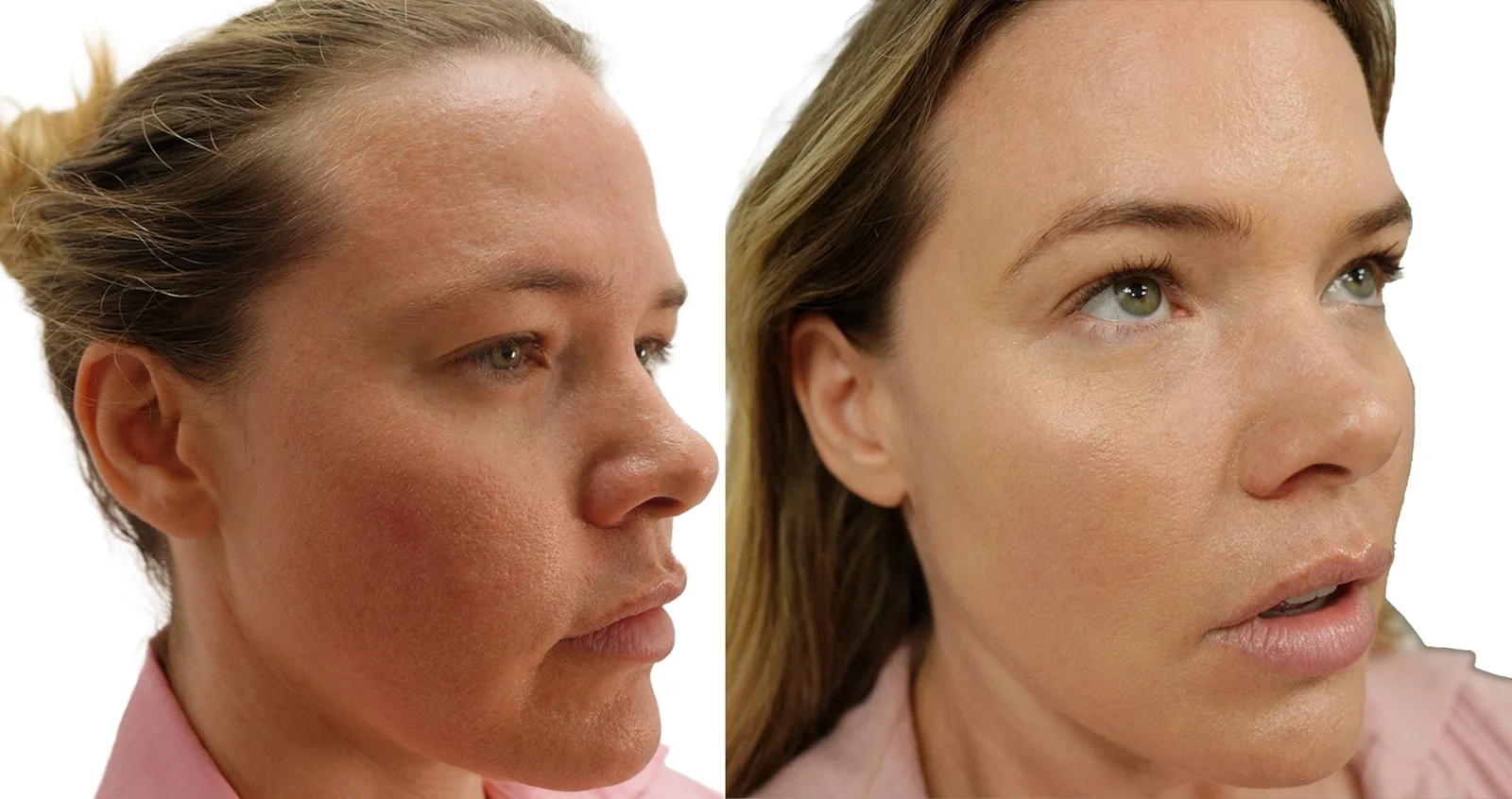 Full face side view before and after showing visible pore refinement and smoother skin texture, London clinic patient