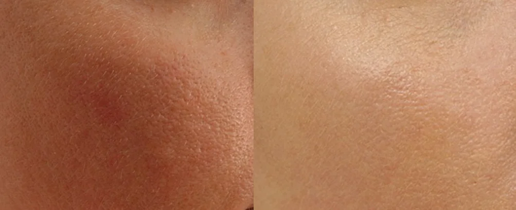Close-up before and after showing smaller pores and refined skin texture, London clinic patient