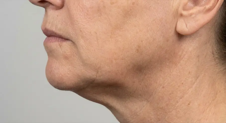 Illustration of side profile showing loss of jawline definition and tissue descent below the jawbone