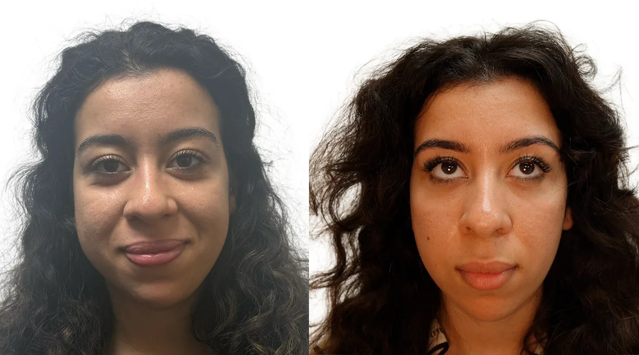 Slimmer lower face and reduced masseter bulk, before and after, front view, London clinic patient