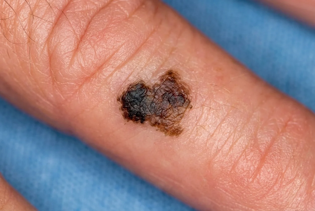 Medical illustration showing the typical clinical presentation of Melanoma on the hand, featuring an asymmetric pigmented lesion with irregular borders