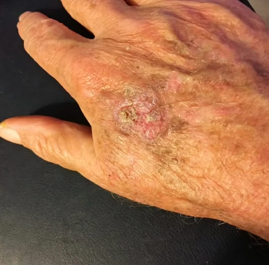 Medical illustration showing the typical clinical presentation of Squamous Cell Carcinoma (SCC) on the hand, featuring a raised crusty lesion
