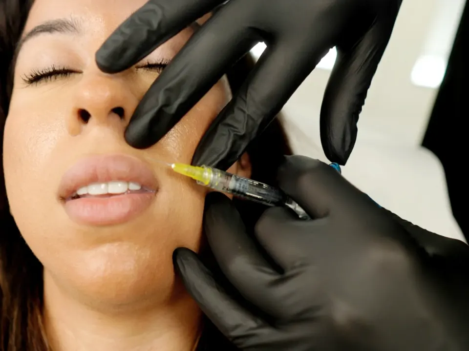Lip Fillers