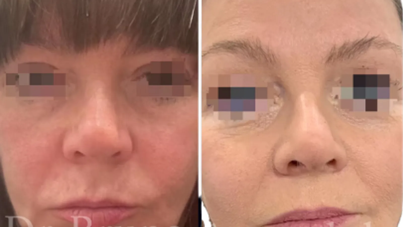 Liquid facelift before and after showing cheek and jawline volumisation with Juvéderm Voluma plus 8 PDO threads for jawline tightening performed by Dr Bruno Amendola at PRP London Clinic