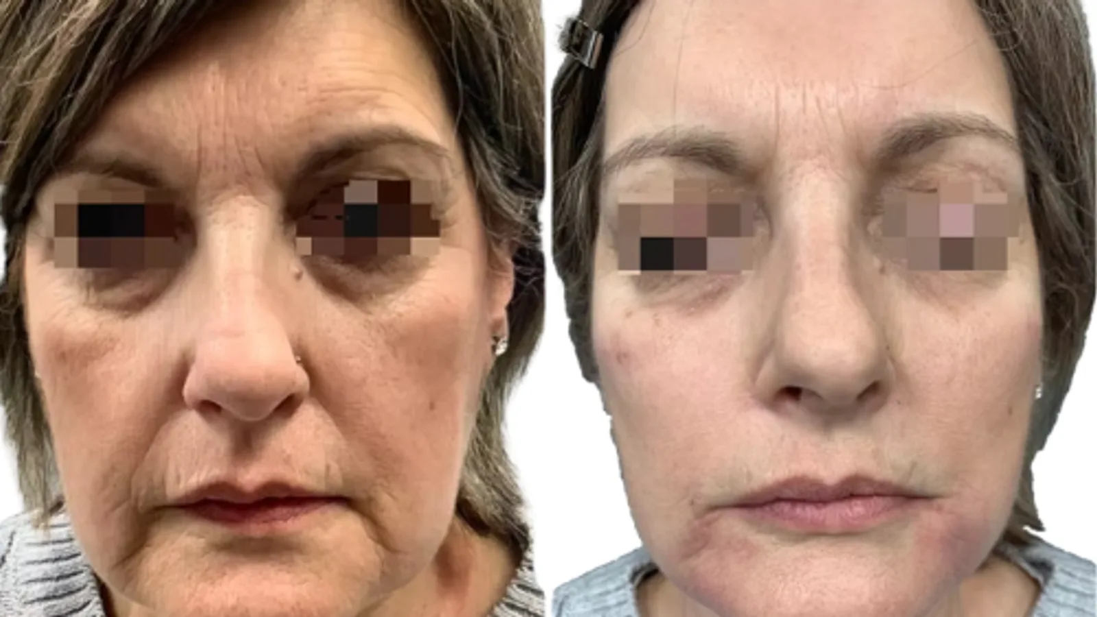Non-surgical facelift before and after showing cheek volumisation with 2ml Voluma, jawline definition with 2ml Voluma, and marionette line correction with 1ml Volift performed by Dr Bruno Amendola at PRP London Clinic