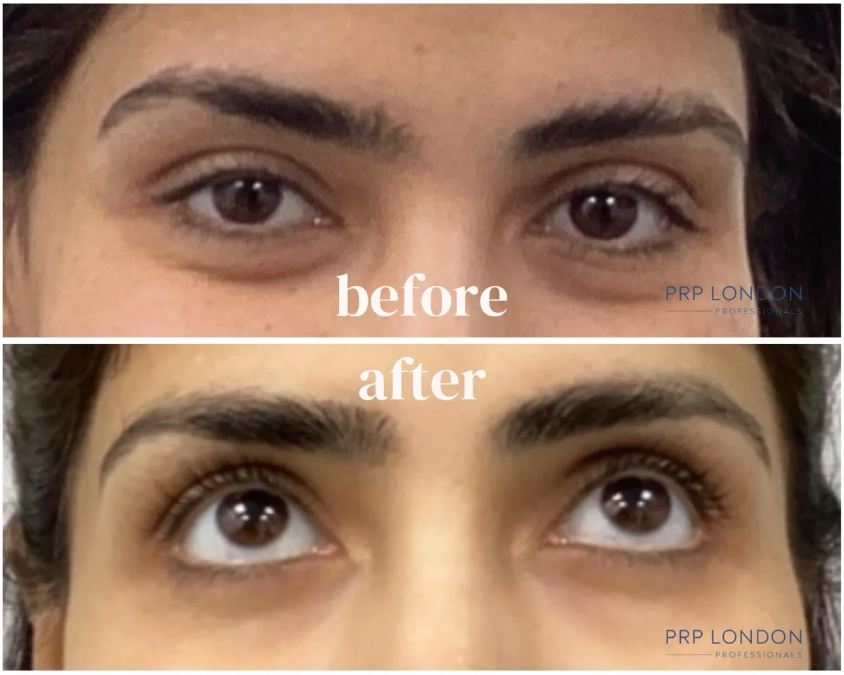 PolyPhil™ + PRF Bio-filler - Dark Circles & Hollowness Results Polynucleotide injections London before and after - dark circles and hollowness treatment with PolyPhil and PRF Bio-filler at PRP London Clinic