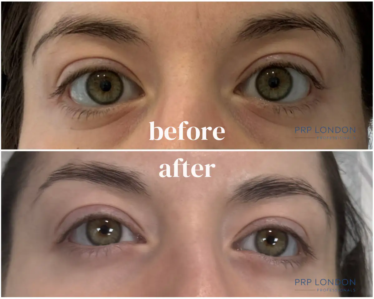 PolyPhil™ + PRF Bio-filler Under-Eye Protocol - Skin Quality Results Polynucleotide injections London before and after - PolyPhil and PRF Bio-filler under-eye treatment showing improved skin quality and reduced vascular shadows at PRP London Clinic