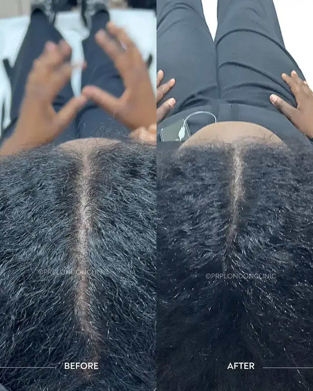 Afro-Textured Hair Density. Improved coverage along the crown and parting lines through enhanced scalp vascularisation.