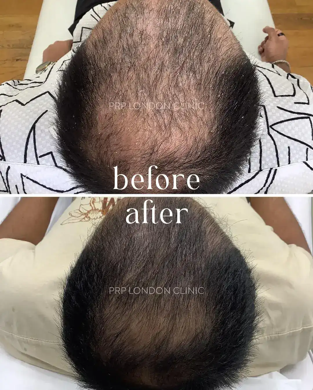 Vertex/Crown Restoration (Male Pattern). Restoration of the crown area by revitalising dormant follicles and increasing hair shaft diameter.