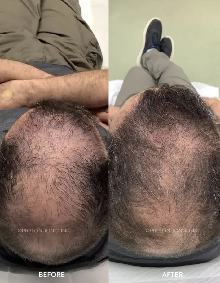 PRP hair loss treatment before and after - advanced male pattern density recovery