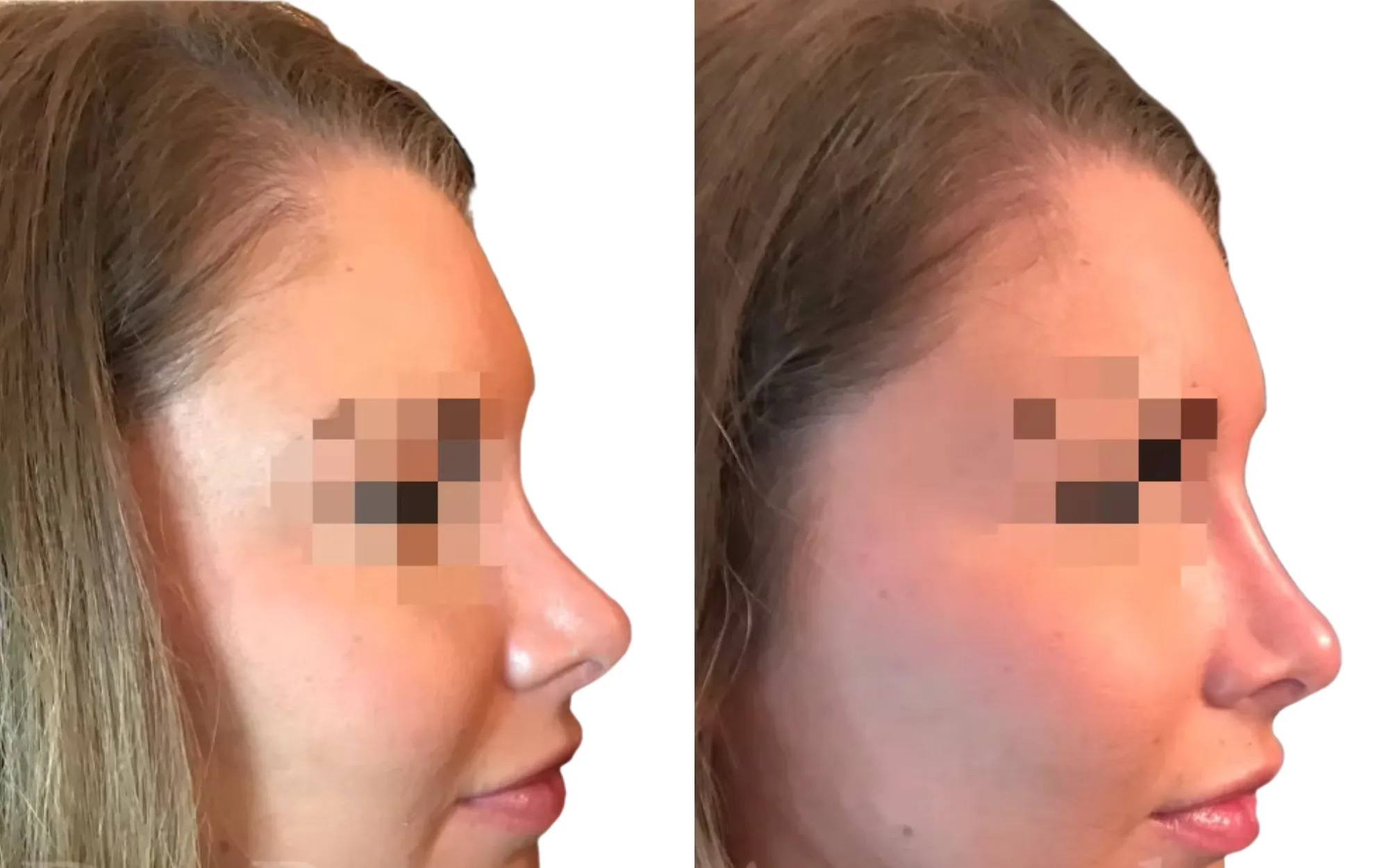 revision non-surgical rhinoplasty before and after London after previous surgical rhinoplasty using 0.7ml Voluma