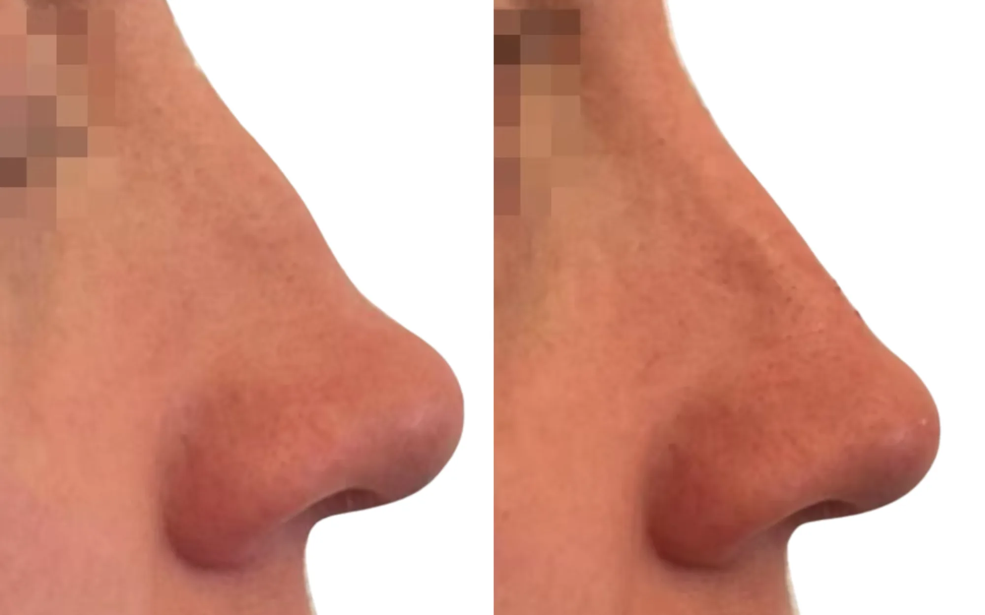 non-surgical rhinoplasty before and after for bump correction and tip hollowness using 0.6ml Voluma