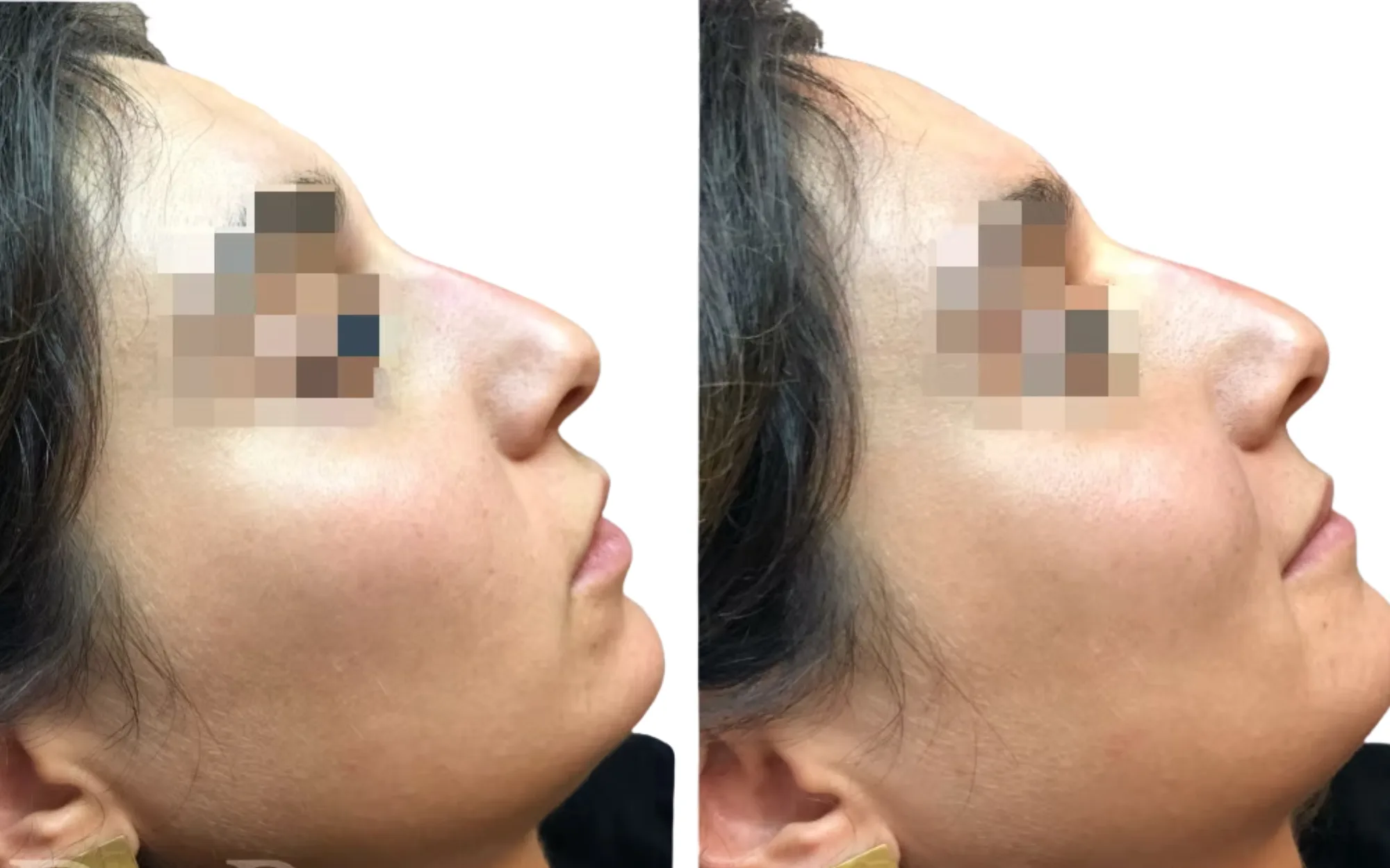 non-surgical rhinoplasty before and after London showing a straighter nose profile with 0.3ml Voluma