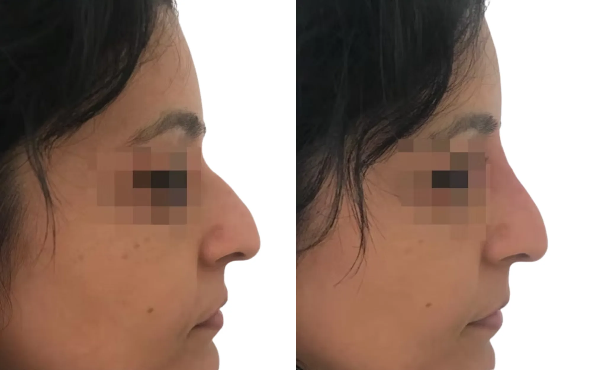 curved nose non-surgical rhinoplasty before and after with upper nose projection using 0.3ml Voluma