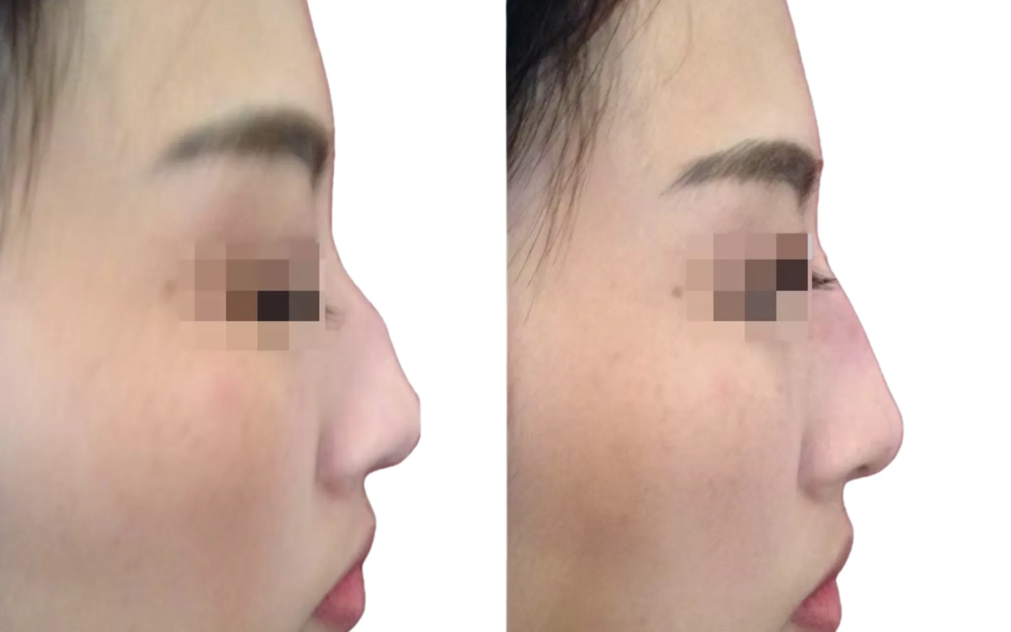 post-traumatic non-surgical rhinoplasty before and after London after a broken nose corrected with 1ml Voluma