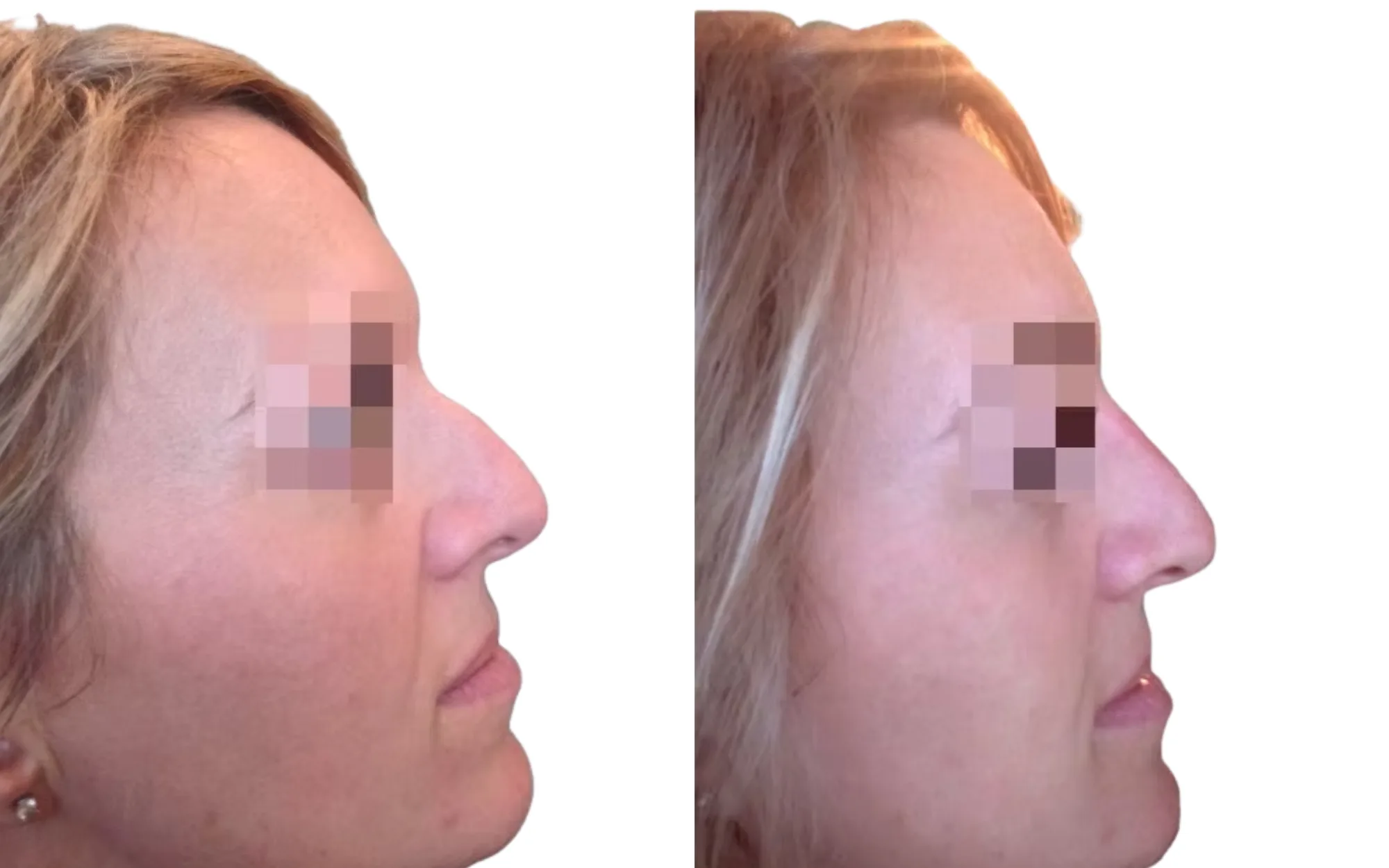 very curved nose before and after non-surgical rhinoplasty using 0.3ml Voluma for dorsal projection