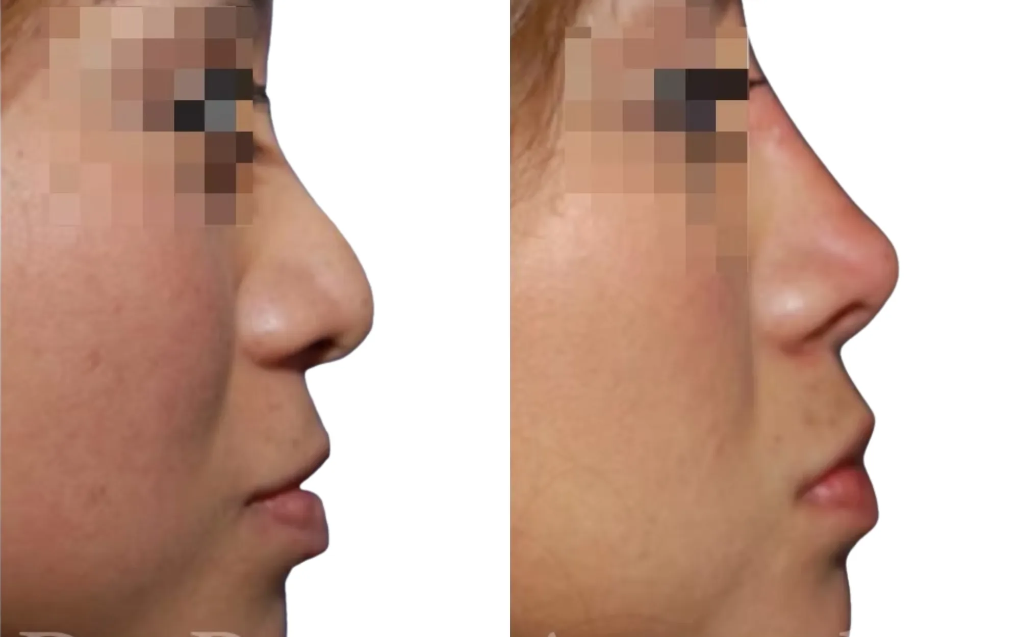 non-surgical nose filler before and after upper bridge straightening with approximately 0.3ml Voluma