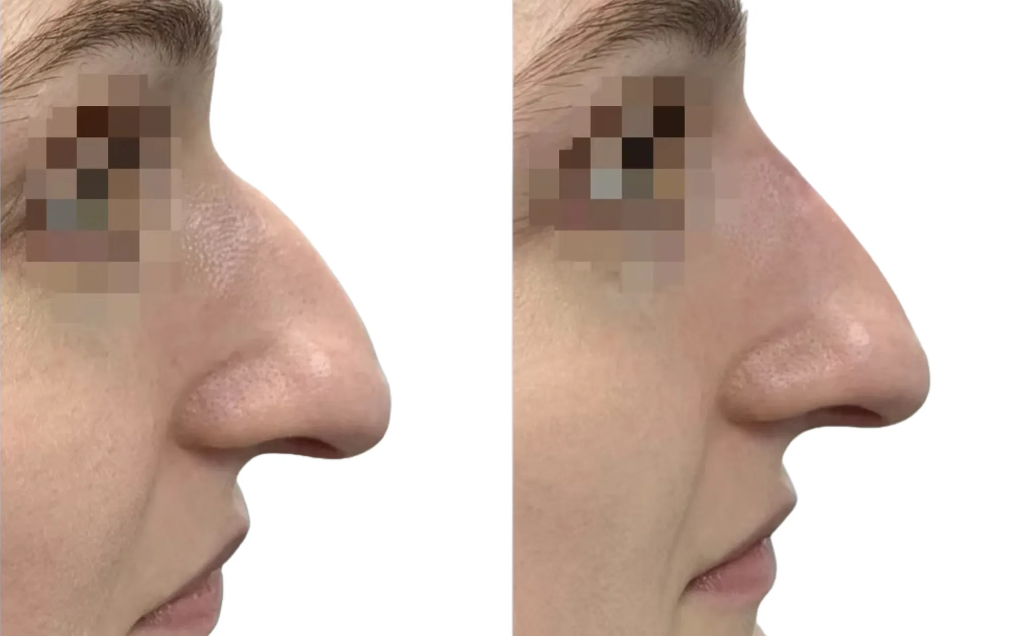non-surgical rhinoplasty before and after London with 0.6ml Voluma to the upper nose and tip