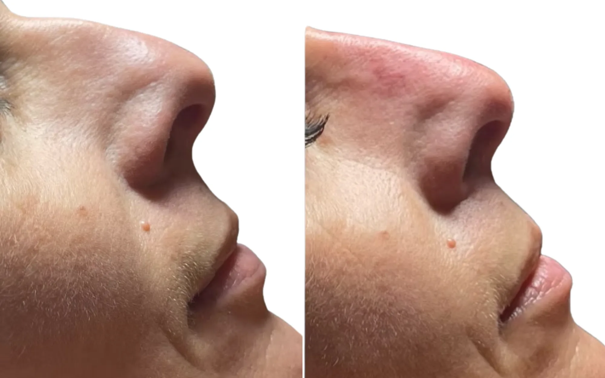 dorsal hump camouflage before and after non-surgical rhinoplasty with 0.4ml Voluma in 3 points