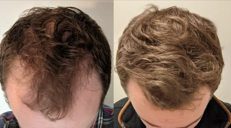 Alex - 4 month Sons hair loss treatment results showing significant regrowth