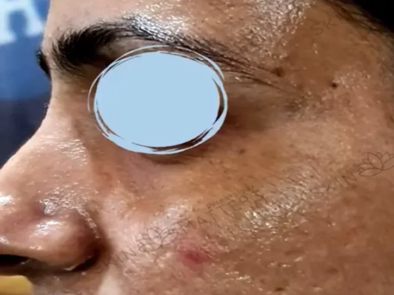 Before Sylfirm X treatment - showing atrophic acne scars