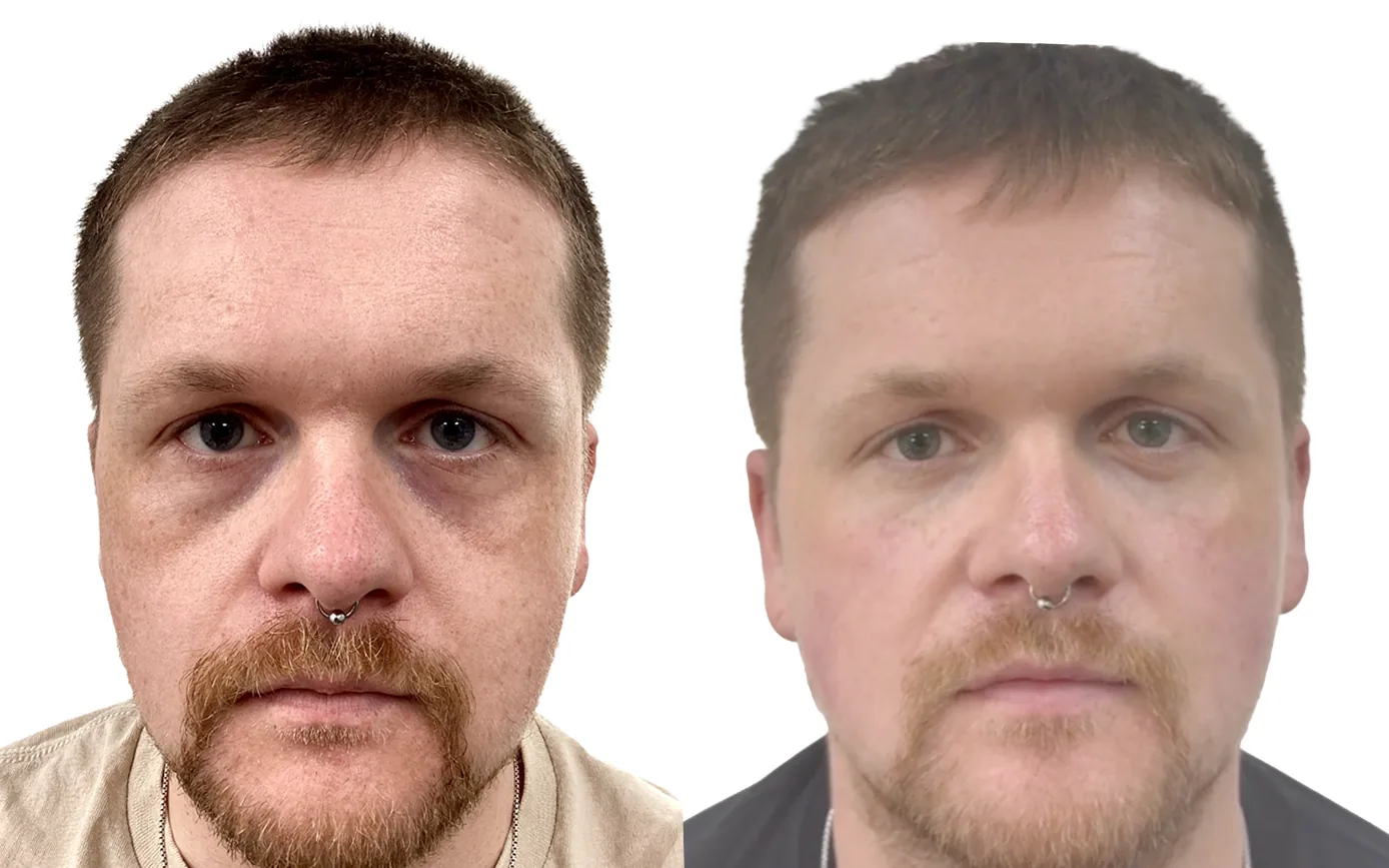 Tear trough and cheek filler before and after, combination mid-face restoration with Teosyal Redensity 2 and Revolax Deep by Dr Mohamed Nafei at PRP London Clinic
