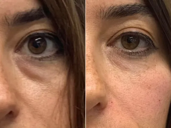 Tear trough filler before and after showing under-eye fat pad correction with 1ml Teosyal Redensity 2 per eye using cannula technique by Dr Bruno Amendola at PRP London Clinic London