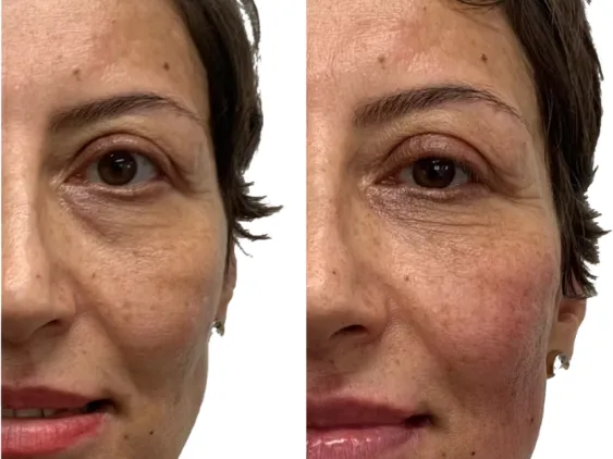 Tear trough filler before and after showing under-eye hollowness correction with 0.5ml Teosyal per eye using cannula entry from cheek by Dr Bruno Amendola at PRP London Clinic London