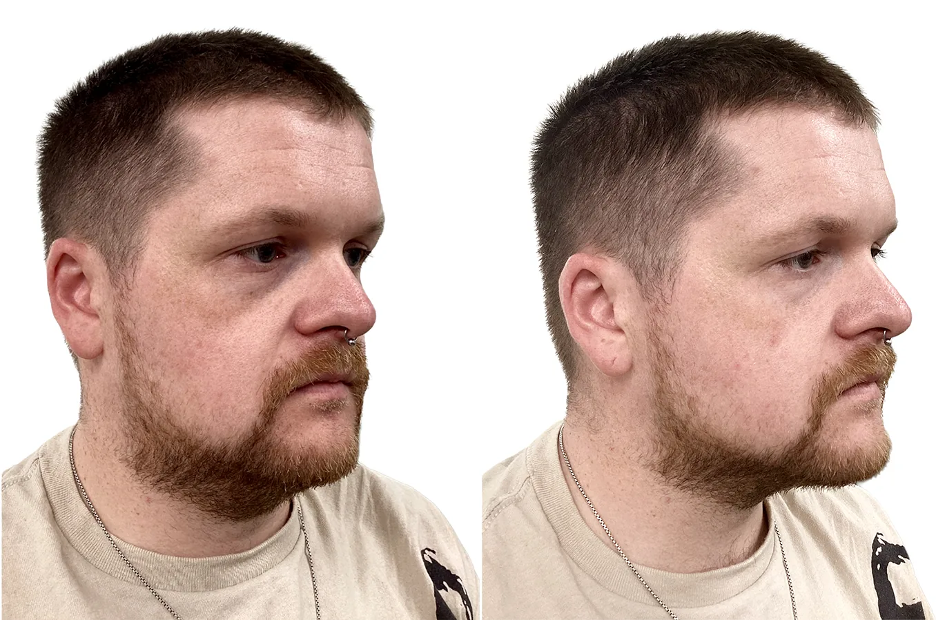 Tear trough filler before and after (side profile view), under-eye hollowness and vascular shadowing corrected with 0.4ml Teosyal Redensity 2 per side via 25G cannula by Dr Mohamed Nafei at PRP London Clinic