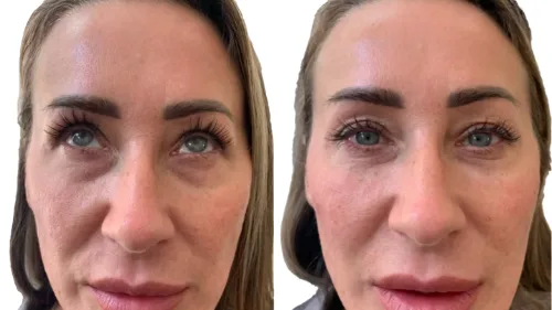 Under-eye filler before and after showing hollowness and dark circle correction with 0.5ml Teosyal per eye by Dr Bruno Amendola at PRP London Clinic London