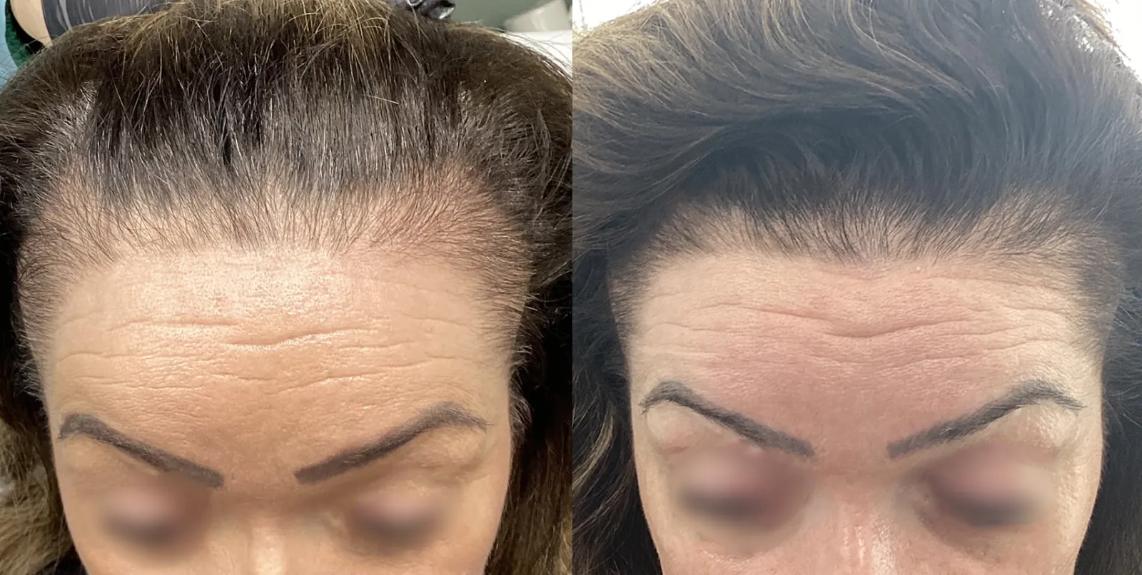 AnteAGE Biosomes and PRP hair treatment before and after showing improved hairline density in traction alopecia, London clinic patient