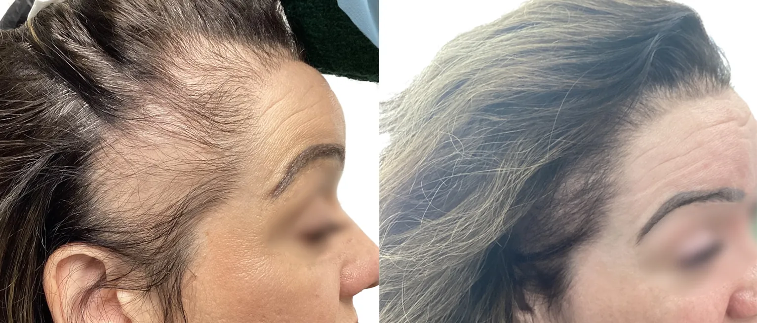 AnteAGE Biosomes and PRP before and after showing new hair growth at the temples after three sessions, London clinic patient