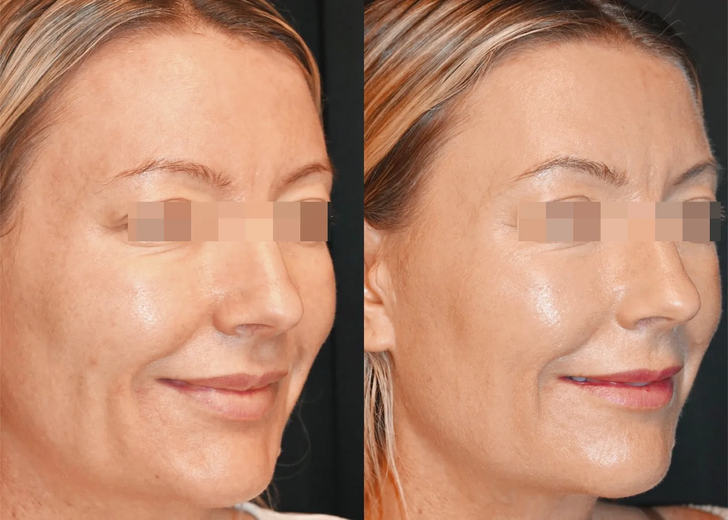 Juläine before and after, softening of the nasolabial fold and improved skin quality at two months after the first session (official Juläine clinical result, clinic The Faculty, injected by Therese Von Post)