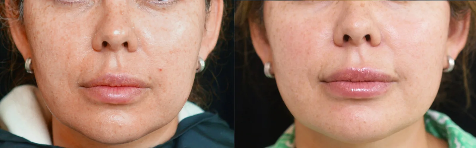 Juläine before and after, softer nasolabial folds and improved skin quality around the lower face at two months after the first session (official Juläine clinical result, clinic Entouch, injected by Annika Harlén)